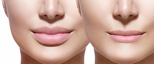 aumento delle labbra con revisione dell'acido ialuronico