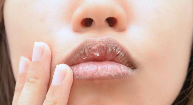 заболявания на устните
