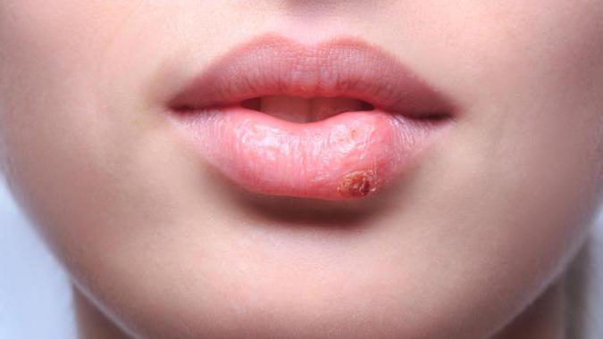 simptomov bolezni ustnic