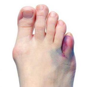 Nožni zglobovi: liječenje i obilježja bolesti stopala