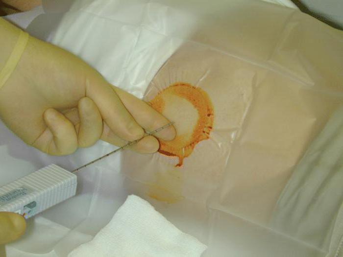 facendo una biopsia epatica per l'epatite