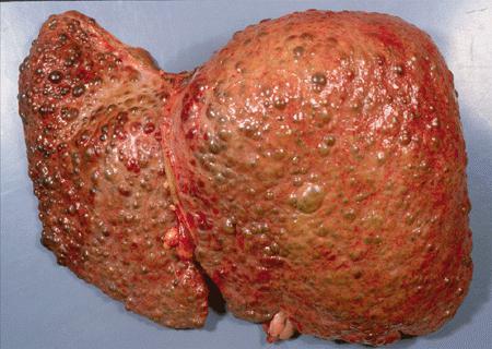 simptomi ciroze jetre