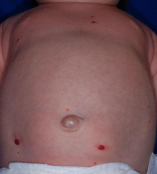 hemangioma jetre u djece