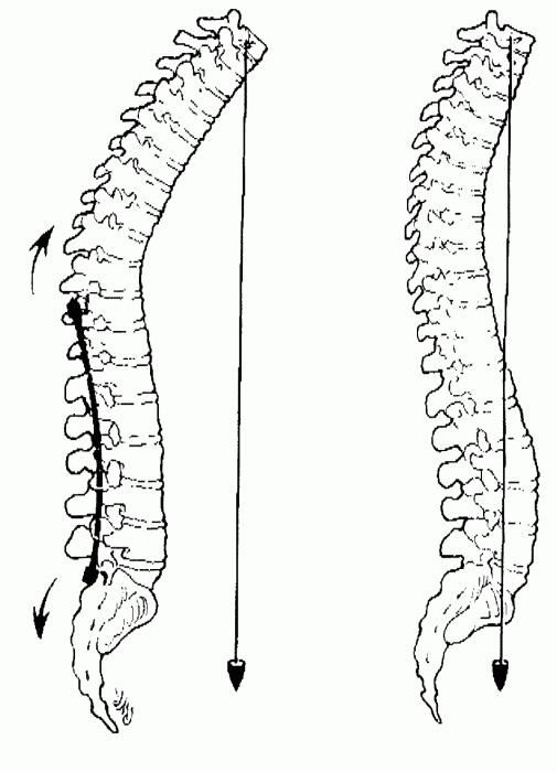 лордоза на лумбалната част на гръбначния стълб