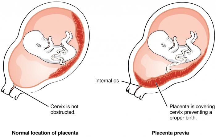 nizka lokacija placente med nosečnostjo 20 tednov
