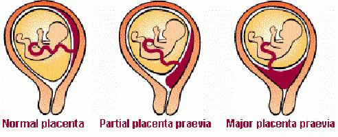 nizka lokacija placente med nosečnostjo 22 tednov
