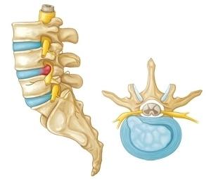 posledice hrbtenice
