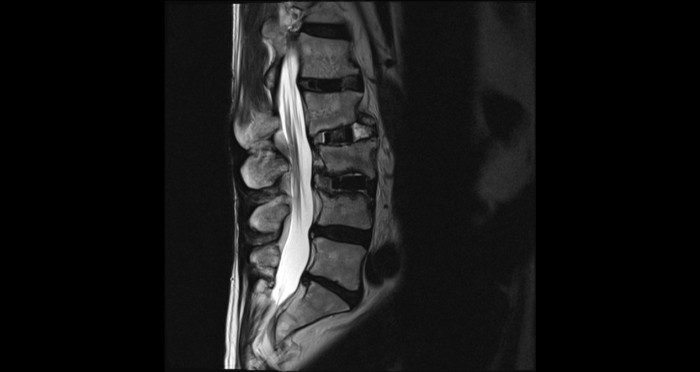Osteocondrosi della colonna vertebrale lombosacrale