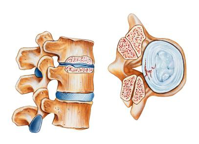 Spondiloartroza ledveno-križne hrbtenice