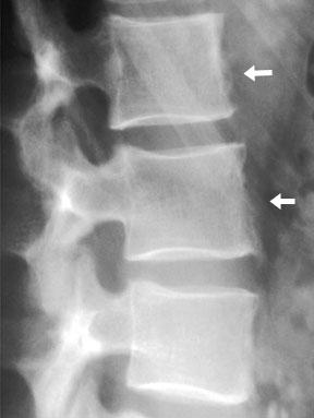 Lumbosakralna hrbtenica.  Simptomi