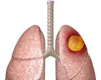 plicní gangréna