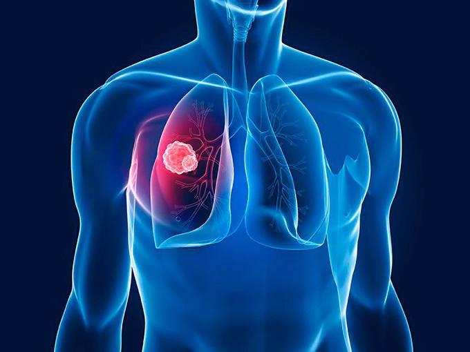 diagnostika plicní gangrény