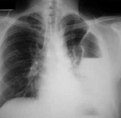 symptomy plicní gangrény