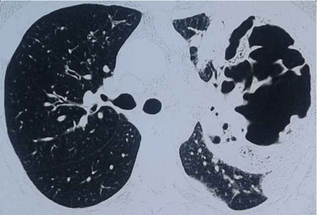 patogenesi della gangrena polmonare