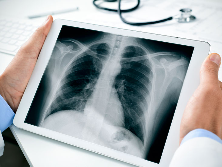 рентгенова снимка на белите дробове