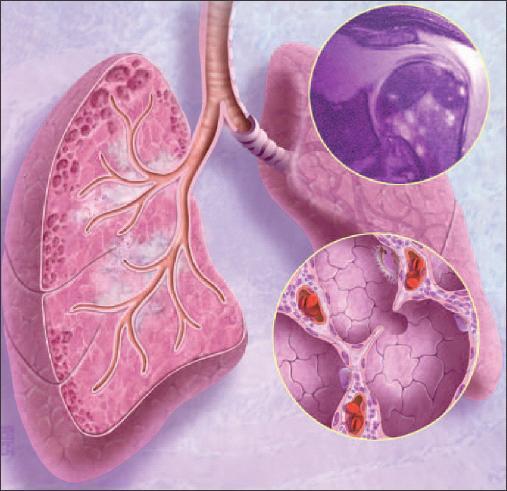 sarkodioz płuc