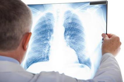 Segmenty płuc na zdjęciu radiologicznym