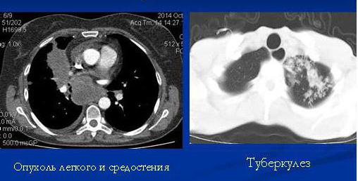 Segmenti polmonari su CT