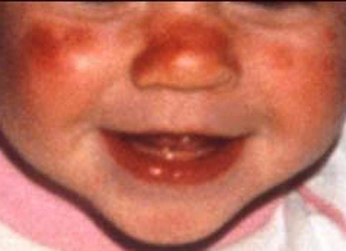 lupus erythematosus u dětí