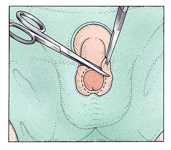 circoncisione maschile