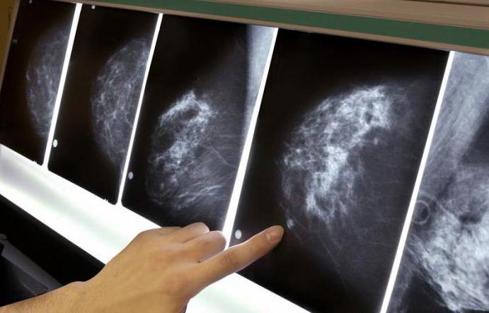 mammografia Cena
