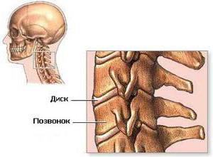 terapia manualna dla osteochondrozy szyjnego odcinka kręgosłupa