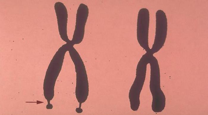 sindrome di cromosoma fragile sindrome di martin bell