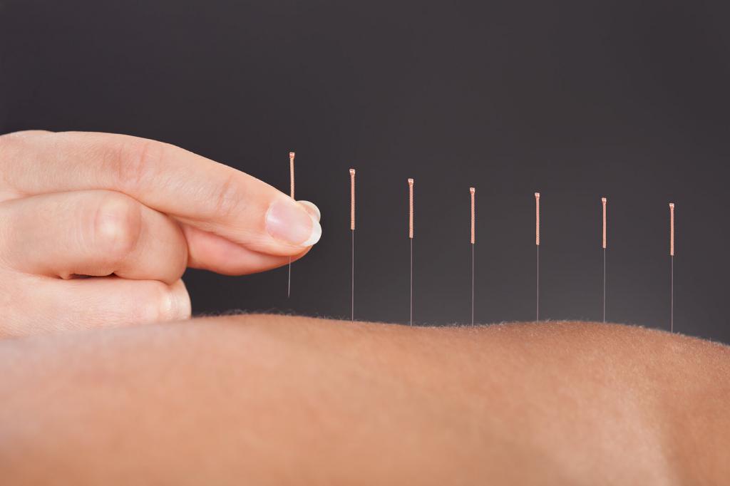 Akupunktura w Chińskim Centrum Medycyny