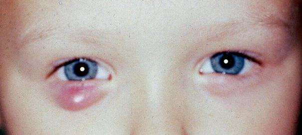 тетрациклинска маст за очи за децу