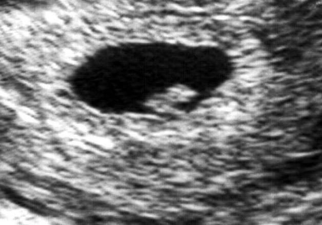 pierwsze USG podczas ciąży