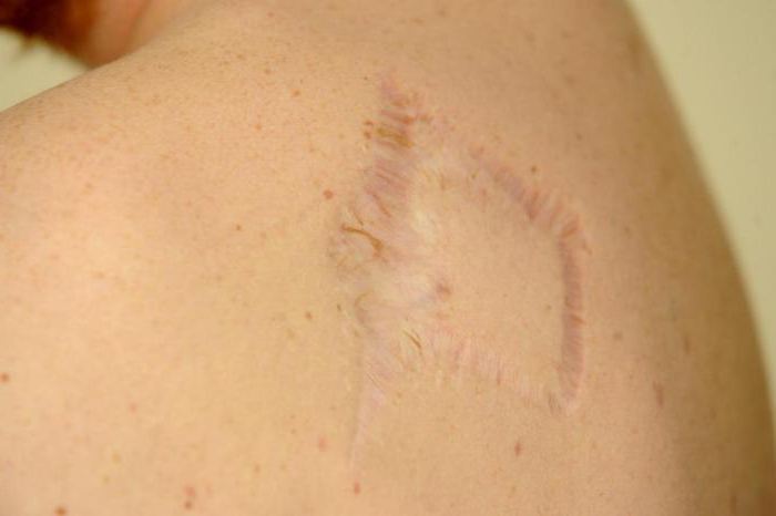 foto della pelle del melanoma