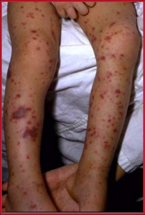 Infezione da meningococco nei bambini con sintomi