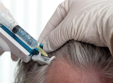 Mezoterapija za pregled kose