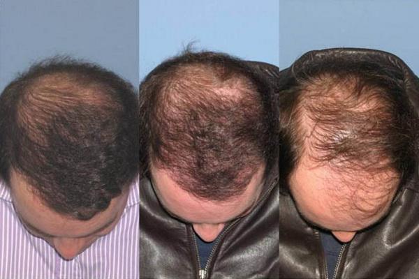 Mezoterapie vlasů před a po