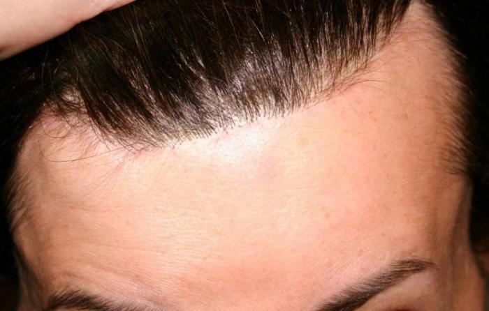 Мезотерапия за растеж на косата