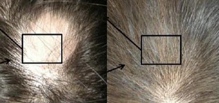 mesoterapia per capelli per uomo