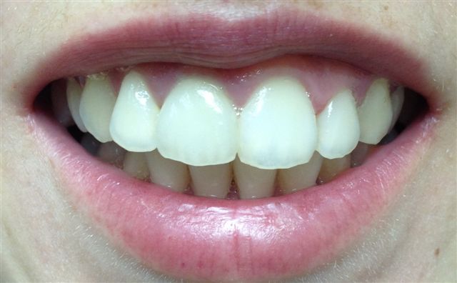 ceramica metalless sui denti anteriori