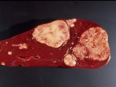prognoza metastaza u jetri