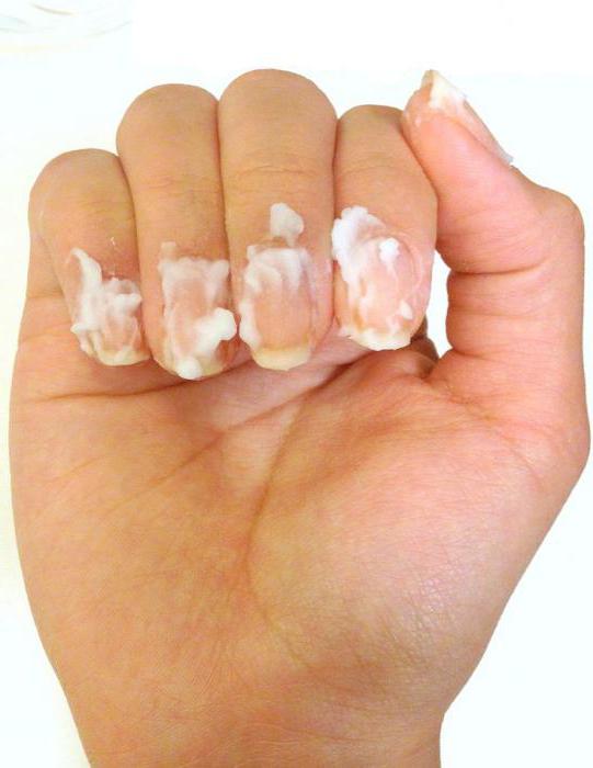 microderil мнения за нокти гъбички