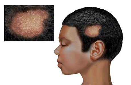 microsporia skalp