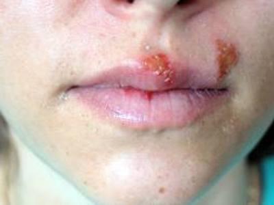 trattamento delle ulcere della lingua