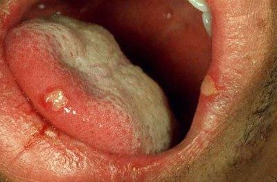 как да се лекуват язви в устата