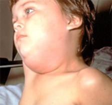 Mumps - onemocnění.  Důsledky