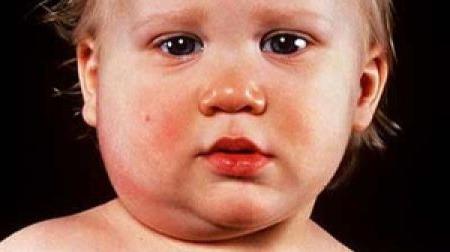 simptomi mumpsa