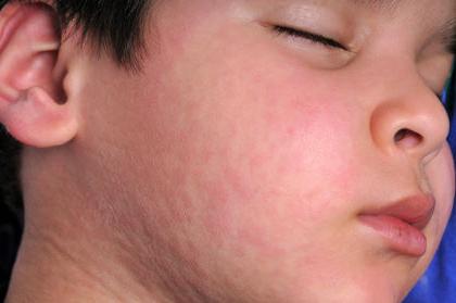 simptomi bolesti mumpsa