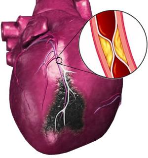 причините за инфаркта на миокарда
