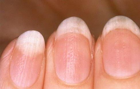 причинява псориазис на ноктите