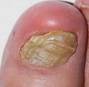 псориазис на лечение на нокти на краката