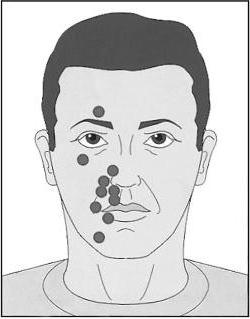 infiammazione del nervo trigemino sul viso