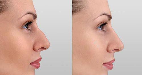 niechirurgiczna plastyka nosa przed i po zabiegu